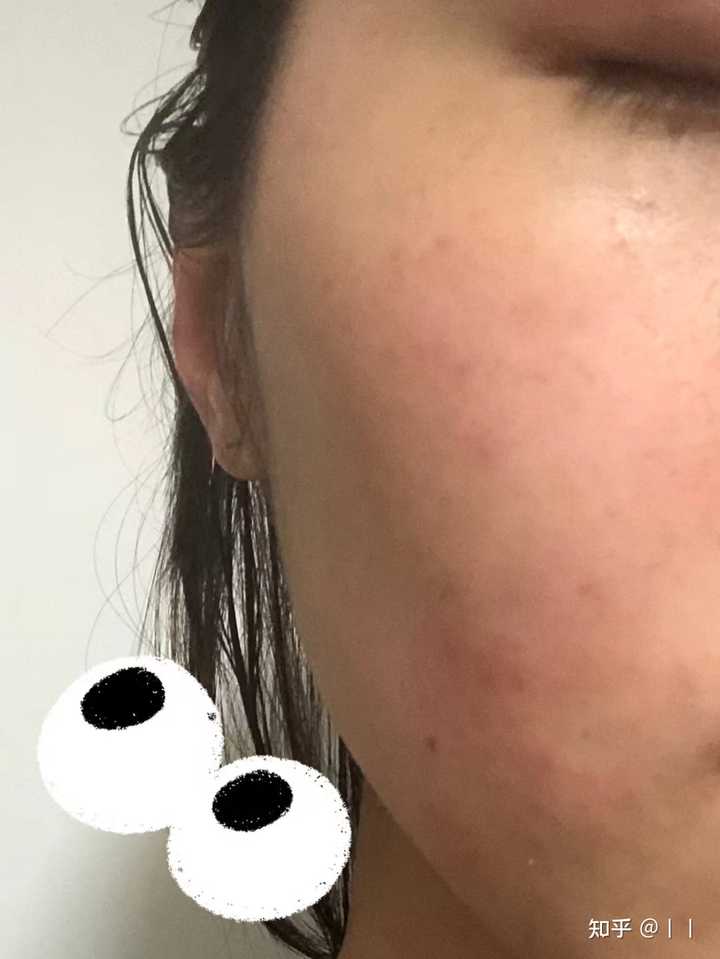 涂皮肤的药过量会怎样?涂皮肤的药过量会怎样？了解过量用药的风险与应对措施
